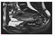 The High Rate of Discordance Between Clinical Symptoms and MRI Findings in Patients with Pelvic Floor Dysfunction